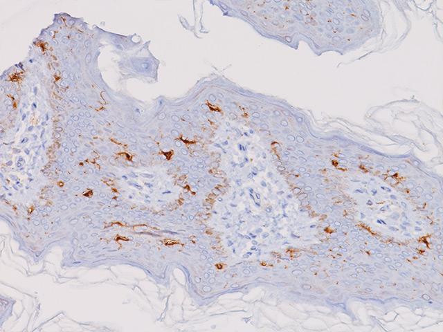 cd1a The Biocare Medical CD1a [O10] is a mouse monoclonal primary antibody used in immunohistochemistry. It is available in concentrate or predilute formats.